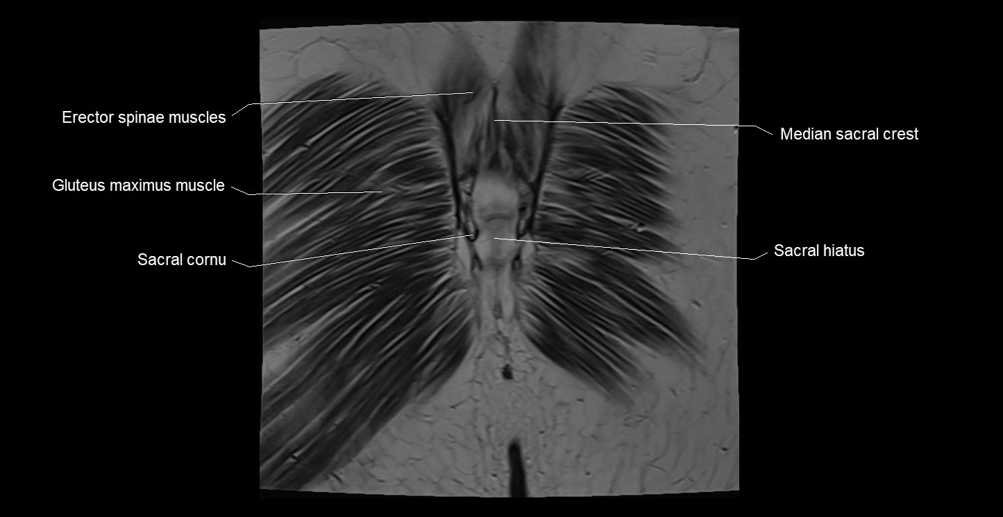 MRI coronal cross sectional anatomy male pelvis image 42.webp